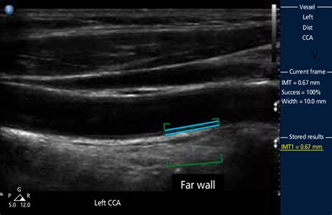 niva versus intimal thickness testing|imt thickness.